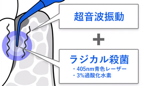 ブルーラジカル治療